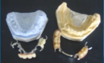 PROTESIS REMOVIBLE FLEXIBLE